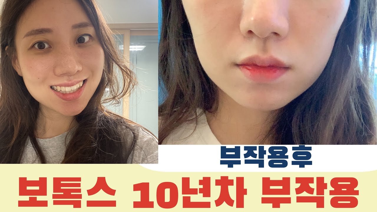 보톡스 주사 후의 예기치 않은 문제