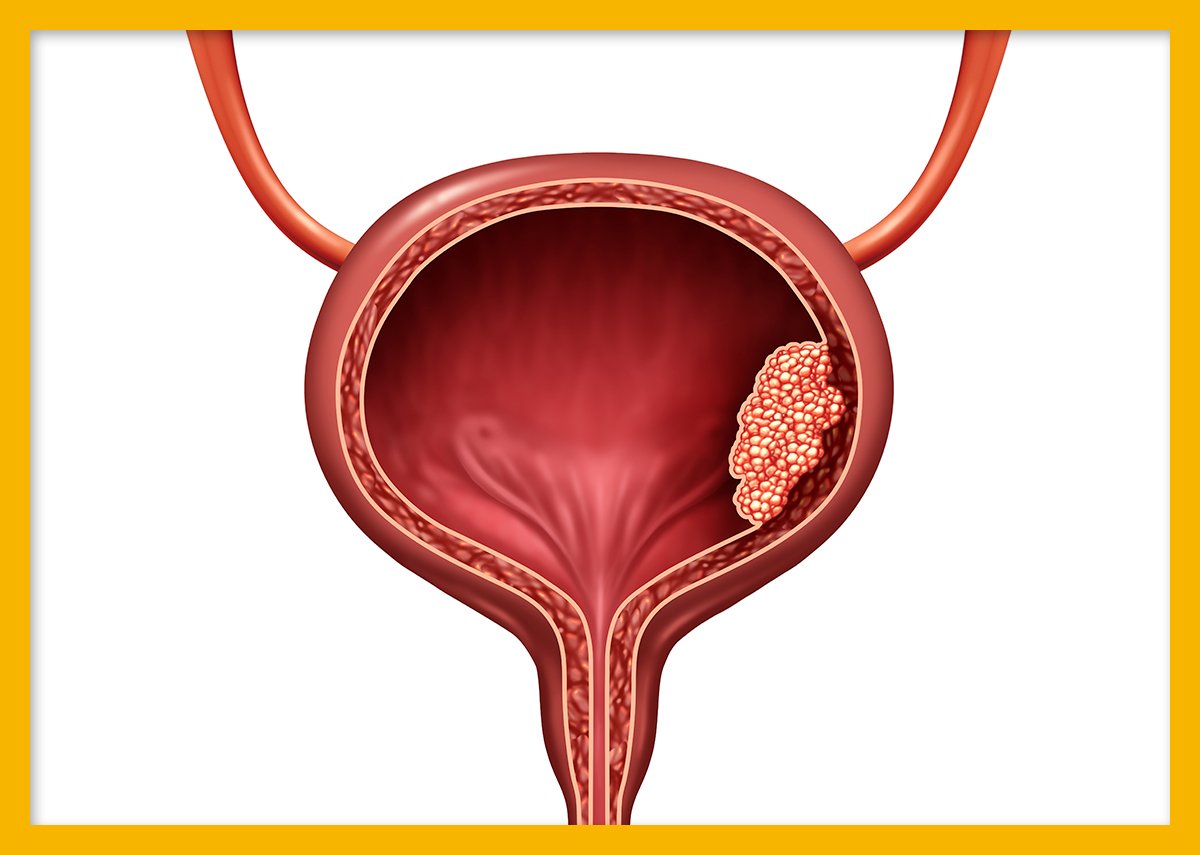 방광암의 종류와 통계